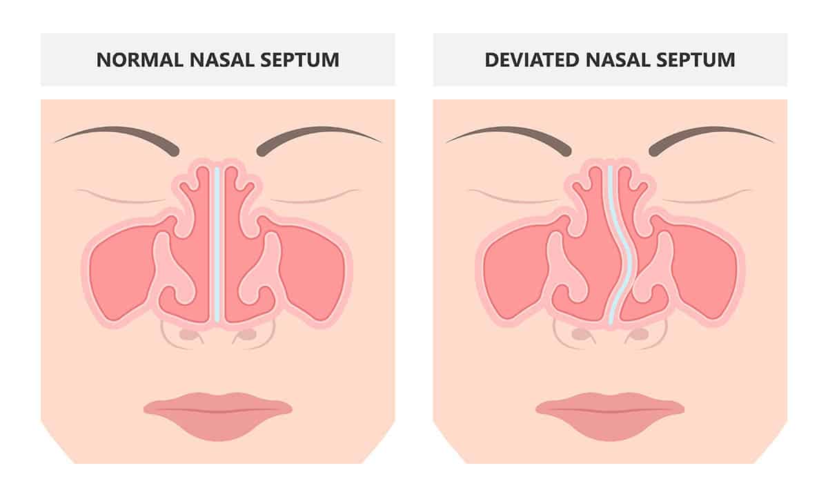 Deviated Nasal Septum and Turbinates